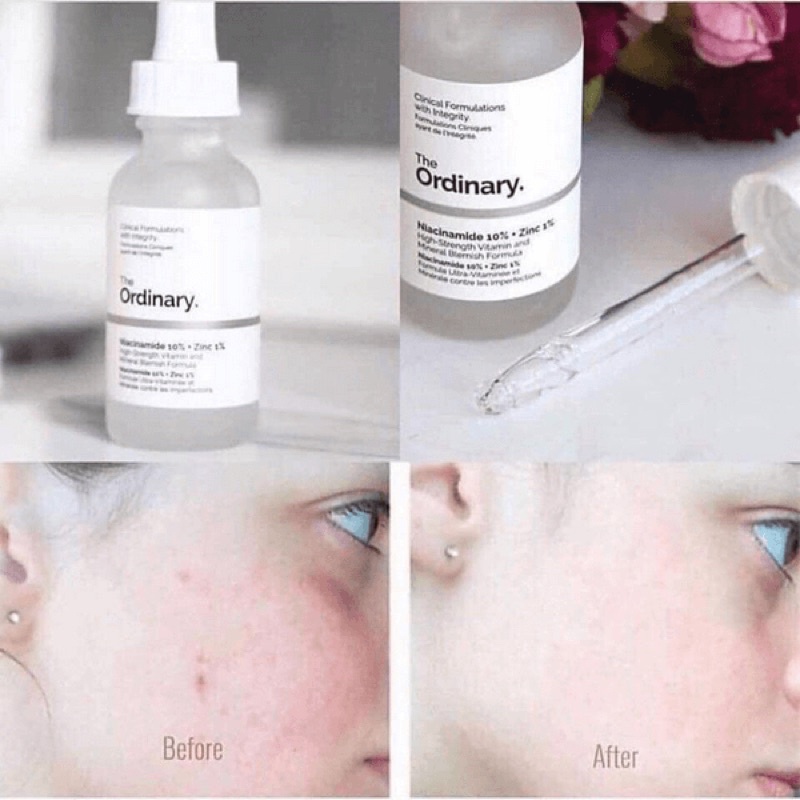 Tinh chất kiềm dầu giảm mụn thâm The Ordinary Niacinamide 10% + Zinc 1% 30ml