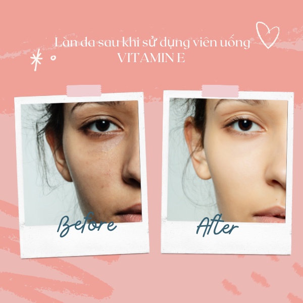 Vitamin E đỏ viên uống đẹp da giảm nám mờ nhăn chống lão hoá