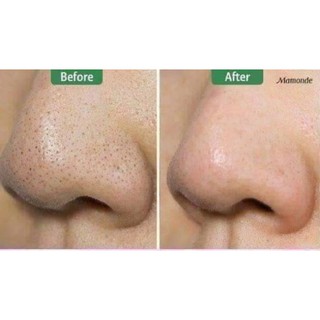 Thanh lí Lột Mụn cám, đầu đen