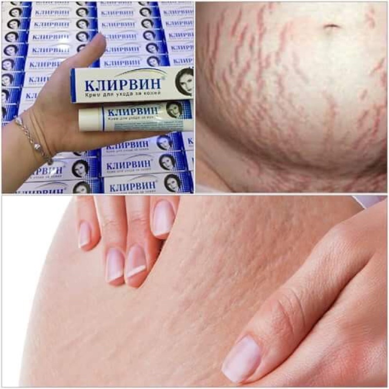 Kem mờ sẹo Klirvin của Nga hỗ trợ giảm thâm sáng da hiệu quả