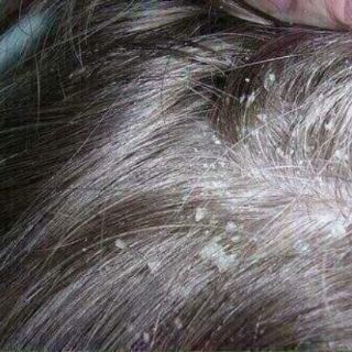 DẦU GỘI TRỊ GÀU BERGAMOT
