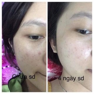 3 hũ nhỏ kem mụn