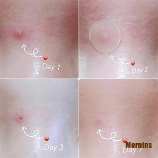 Ms❀Set 36 Miếng Dán Mụn Hydrocolloid Và Mụn Thịt Tiện Dụng