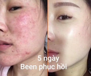 PHỤC HỒI BEEN CHO DA HƯ TỔN