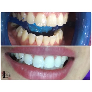thuốc tẩy trắng răng