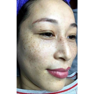 Kem hút nám dùng cho spa( Kem D: Ức chế nám sâu)