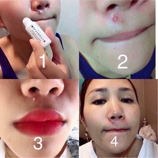 Chấm mụn clinda-m thái lan