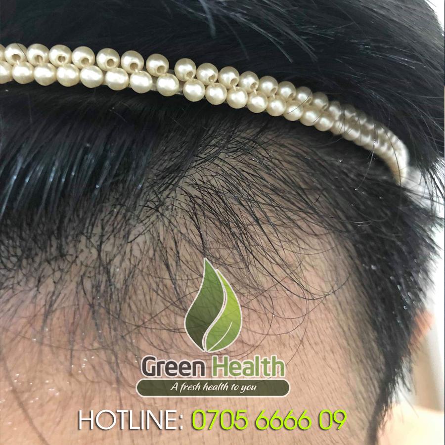 Serum mọc tóc Hair 4U Pro