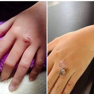 Thuốc đặc trị mụn cơm mụn cóc mắt cá chân