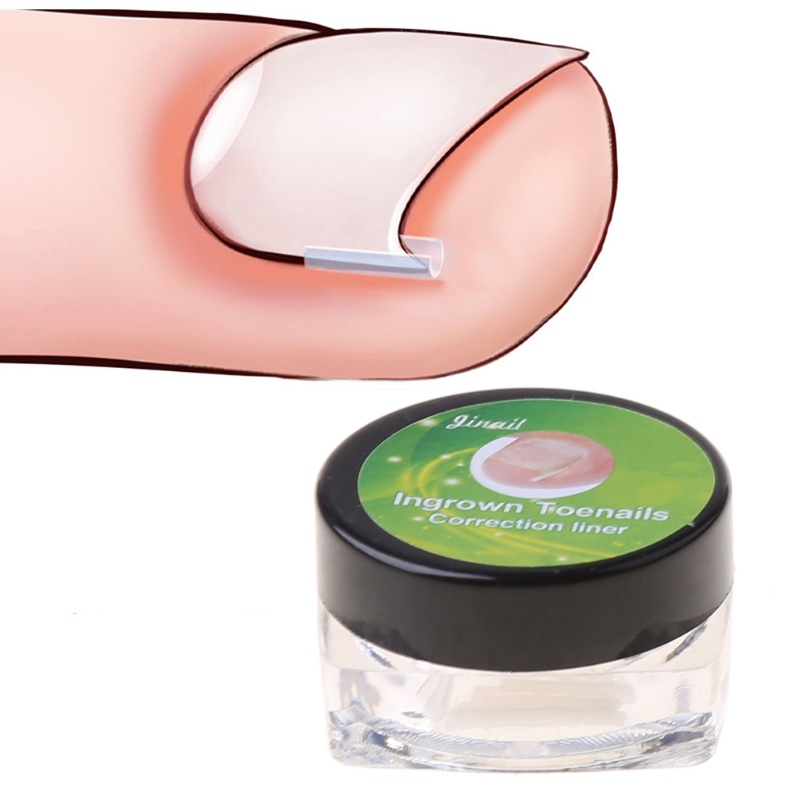 [Hàng mới về] 10 Dụng cụ chỉnh sửa móng chân mọc ngược tiện dụng