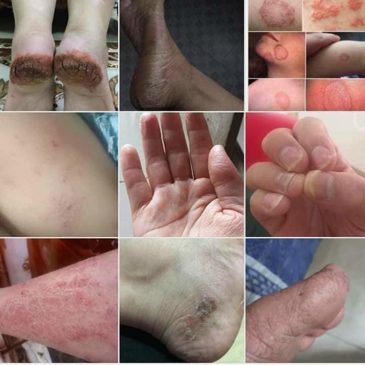 Kem bôi da nấm, ngứa,... - Hàng có sẵn - Kem