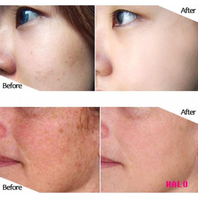 KEM SẸO KLIRVIN – NGA - Xóa Sẹo Mờ Thâm Nám Cấp Tốc- 25Gr | BigBuy360 - bigbuy360.vn