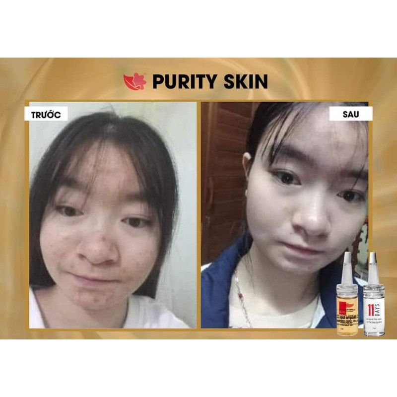 Tinh Chất Mụn PURITY SKIN Linh Hương Loại Bỏ Mọi Loại Mụn