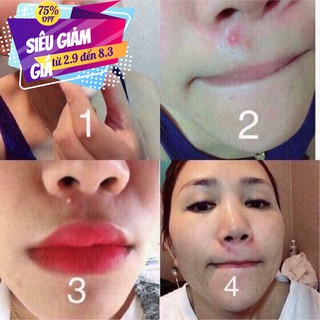 Thuốc chấm mụn clinda-m thái lan