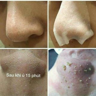 Ủ mụn đầu đen mụn cám