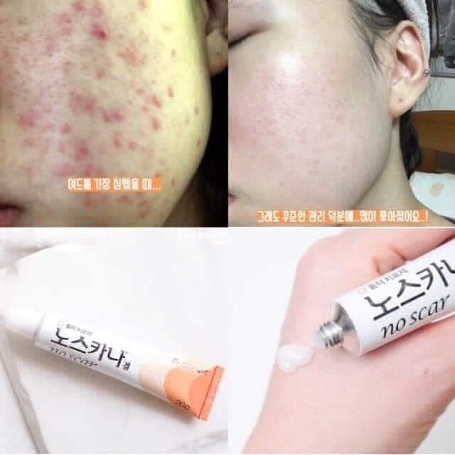 Kem sẹo Hàn Quốc Noscarna