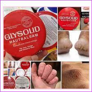Kem nẻ của Đức GLYSOLID CHỐNG DA KHÔ NỨT NẺ 100ML