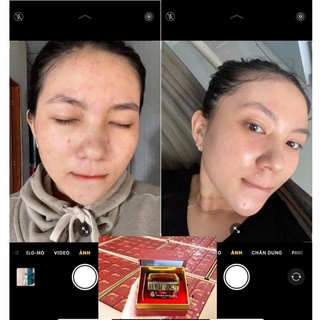 Cao Mụn Sâm Đỏ 36 Vị