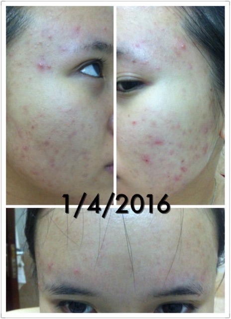 Kem dưỡng ẩm da mụn Acne.org Moisturizer - Chính hãng