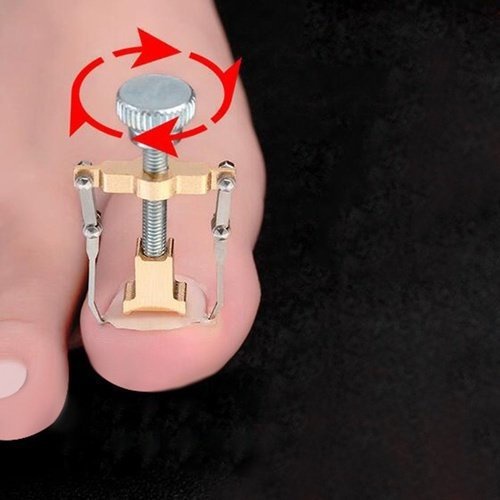 Dụng Cụ Chỉnh Hình Móng Chân Mọc Ngược Móng Quặp