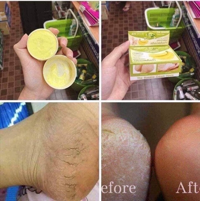 KEM CHUỐI NỨT GÓT CHÂN THÁI LAN | BigBuy360 - bigbuy360.vn