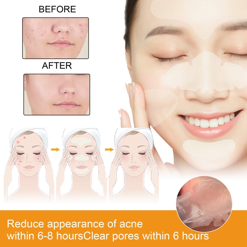 Mặt Nạ Lột Mụn hydrocolloid 5 Miếng Dán Cỡ Lớn Cho Vùng Mũi / Đầu / Cằm