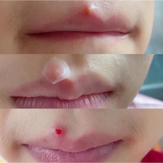 Miếng dán mụn Cosrx 24 miếng đỏ