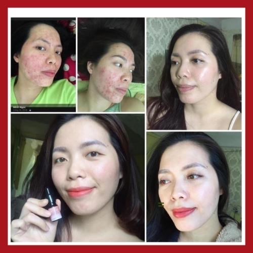 Serum Giảm Mụn CARAMEL ESSENCE Nhật Bản Giảm Ngừa Mụn Xóa Thâm Mờ Sẹo Tái Tạo Dưỡng Da Căng Bóng 5ml