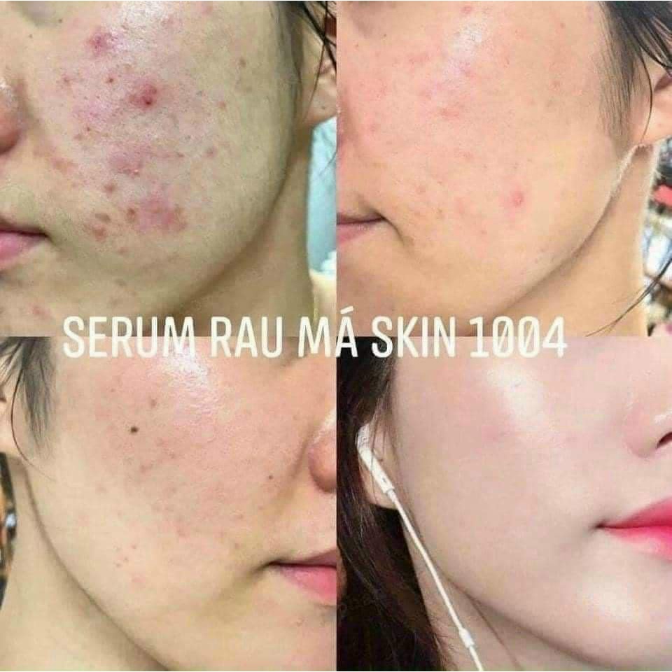 Tinh Chất Serum Skin1004 Giảm Mụn, Mờ Thâm, Làm Dịu Và Phục Hồi Da Skin1004 Madagascar Centella Ampoule 55ml