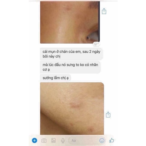 Kem Chấm Mụn,Kem Xẹp Mụn Clinda_m - BL