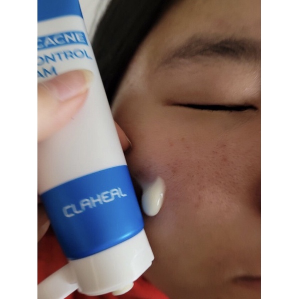 Kem se cồi mụn Claheal chuẩn Hàn | BigBuy360 - bigbuy360.vn