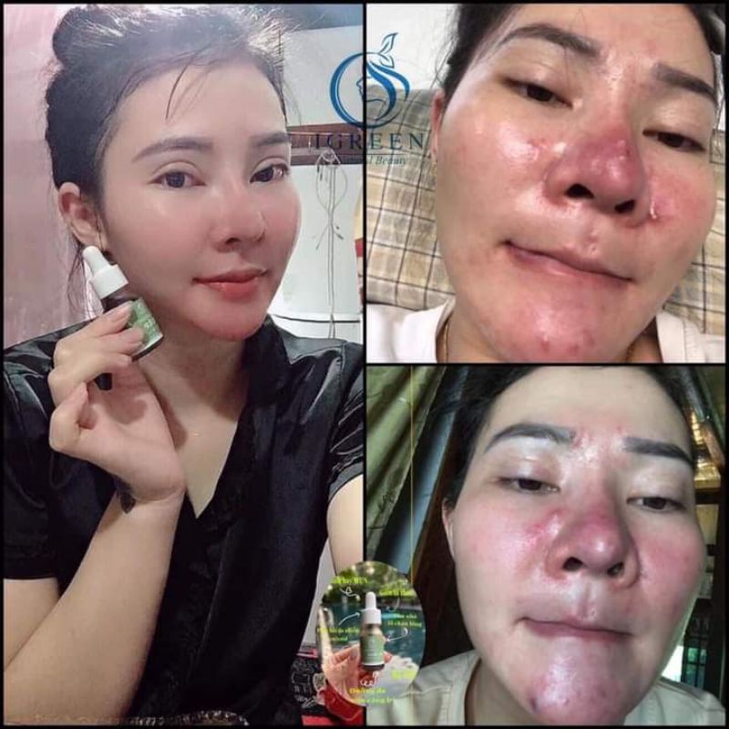 Serum dưỡng da chính hãng IGREEN 10ml chiết xuất từ diếp cá giảm mờ thâm sáng da không gây kích ứng