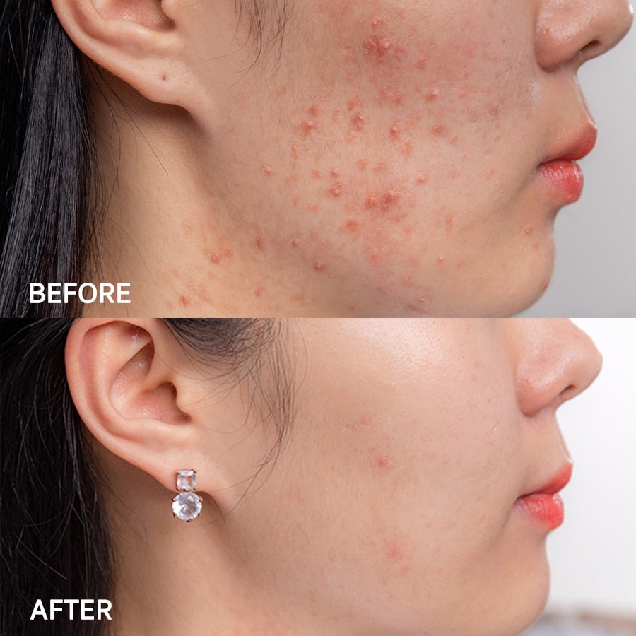 Kem Giảm Mụn Eucerin Pro Acne Solution A.I Clearing Treatment