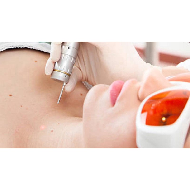 HCM  Xóa Mụn Thịt Không Để Lại Sẹo Công Nghệ Fractional CO2