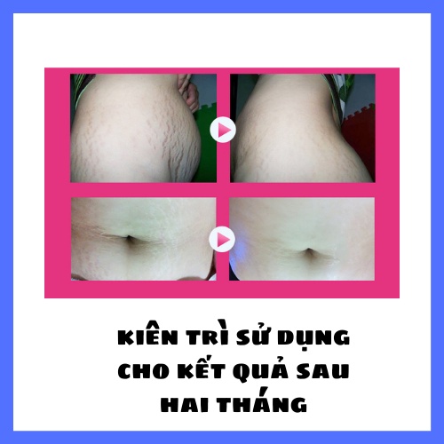 ( MUA 1 TẶNG KÈM 3 SP) Kem phục hồi rạn da,ngừa rạn da Mommy 100G kem 100% thảo dược dùng cho nam nữ cho mọi loại da