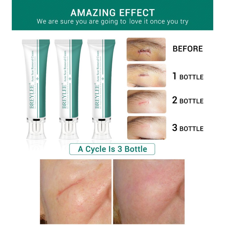 Có Hàng Breylee Gel Xóa Sẹo 30G Điều Trị Sẹo Mụn Xóa Vết Rạn Da Làm Trắng Thanh Toán Khi Nhận Hàng