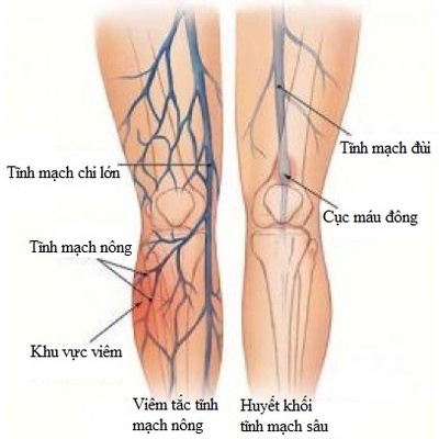 Kem Bôi giãn tĩnh mạch Abtei Venen Aktiv 125ML - Giảm suy giãn , bền vững thành mạch - Nhà Thuốc Hạnh Phúc