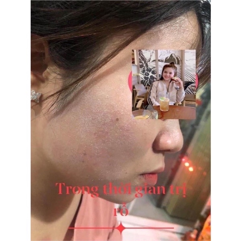 Kem tái tạo da mụn nám | BigBuy360 - bigbuy360.vn