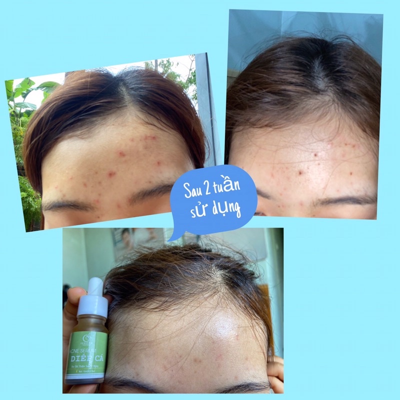 Serum Diếp Cá GIẢM MỤN, THÂM, SE KHÍT LỖ CHÂN LÔNG. | BigBuy360 - bigbuy360.vn