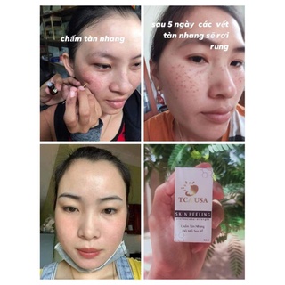 SÉT TCA CHẤM PEEL NÁM TÀN NHANG 35%