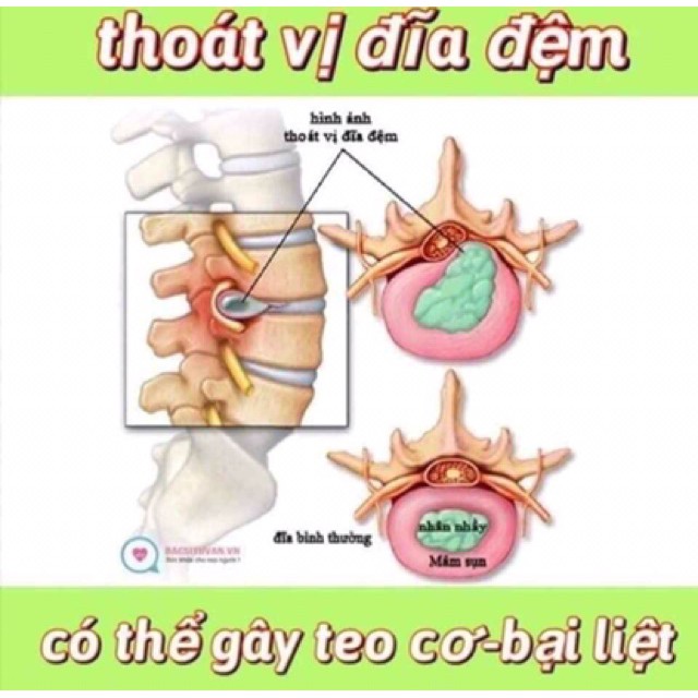 Viên Thoái Hoá Đốt Sống Cổ Hàn Quốc