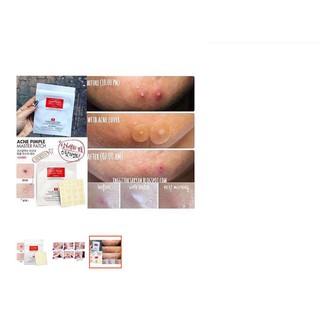 Miếng dán mụn Cosrx Acne Pimple Master Patch