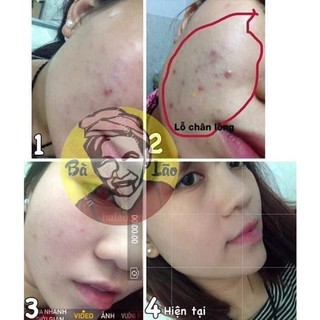 Sạch Mụn Cao Cấp Bà Lão - Sạch Mụn Liền Da