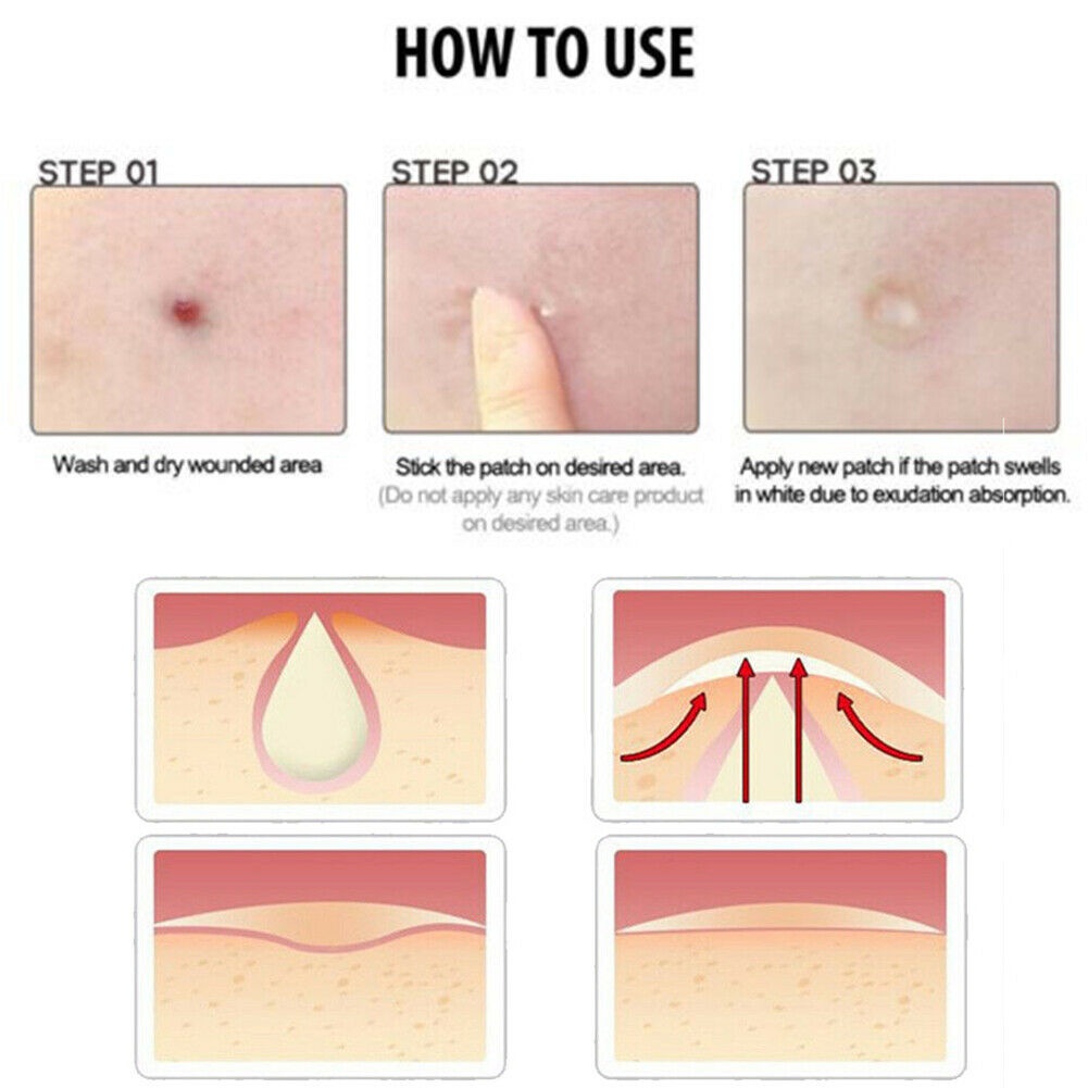 HOT! 36 Chiếc Hydrocolloid Mụn Vô Hình Pimple Master Miếng Dán Loại Bỏ Da Miếng Dán Mụn Đầu Đen Tẩy Vết Thâm Do
