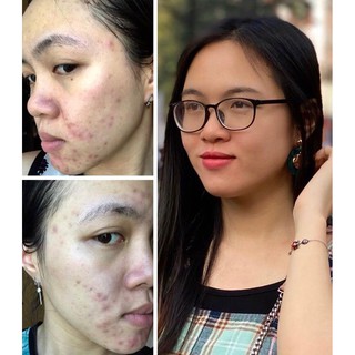 Bột rửa mặt OGANA cho da mụn