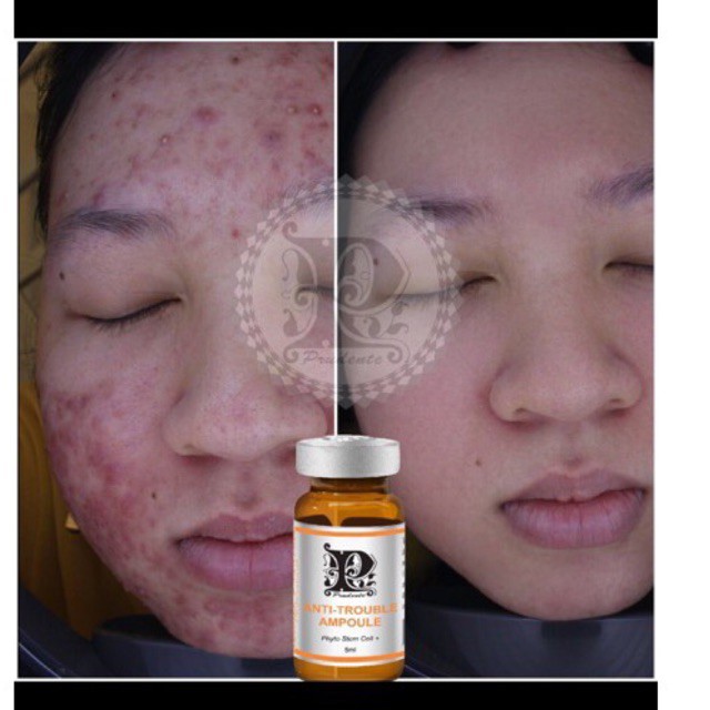 Serum Mụn Anti Trouble Ampoule  5 ml/ chai