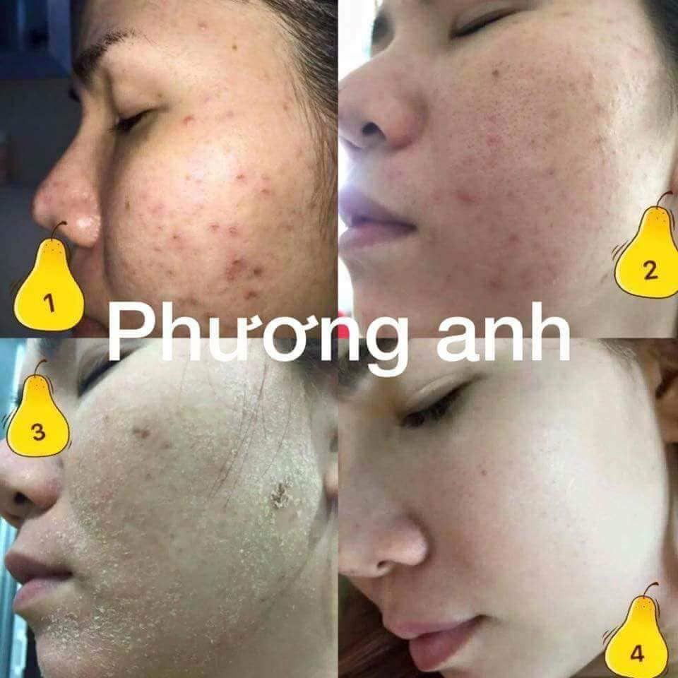 [CHÍNH HÃNG]⚡Serum Thảo dược tái tạo da Yody White Phương Anh làm sạch mụn nám tàn nhang | BigBuy360 - bigbuy360.vn