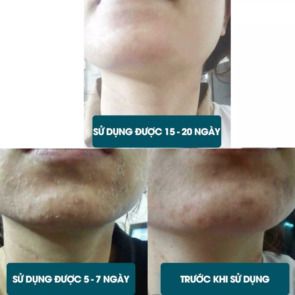 Kem Thay Da Sinh Học HERBAL PEEL của Behome Spa | Hàng Chính Hãng