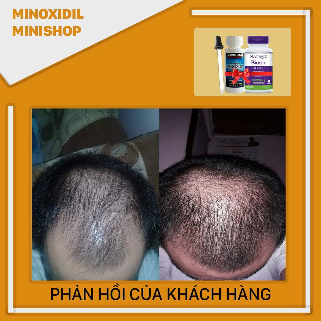 Minoxidil 5% Mọc Râu Dạng Lỏng Kirkland Combo Biotin