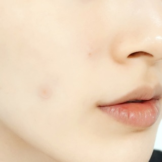 Miếng Dán Trị Mụn Cosrx Acne Pimple Master Patch